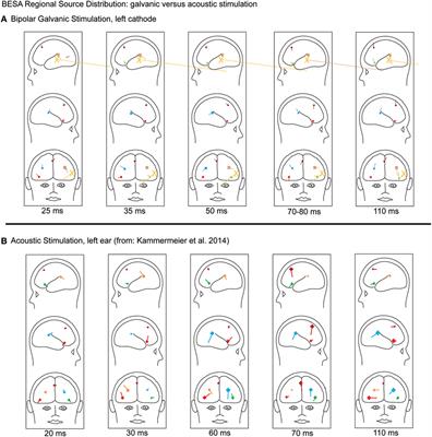 Intermediate Latency-Evoked Potentials of Multimodal Cortical Vestibular Areas: Galvanic Stimulation